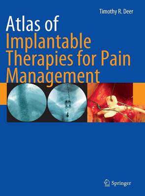 Atlas of Implantable Therapies for Pain Management