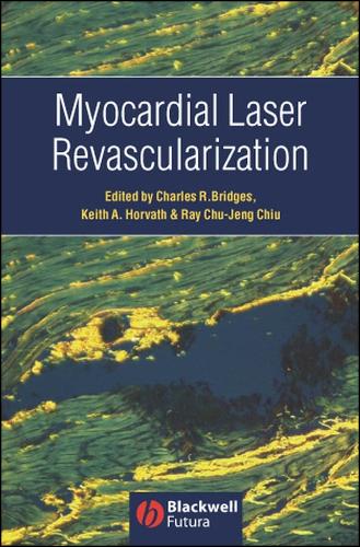 Myocardial Laser Revascularization