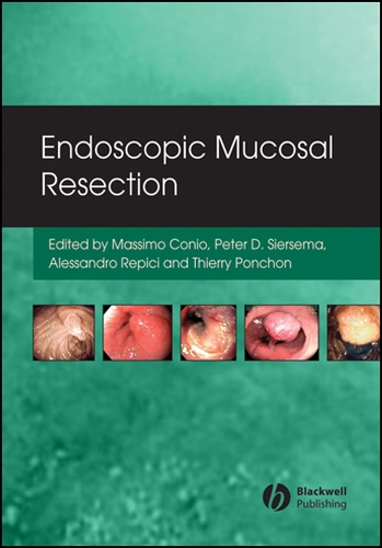 Endoscopic Mucosal Resection