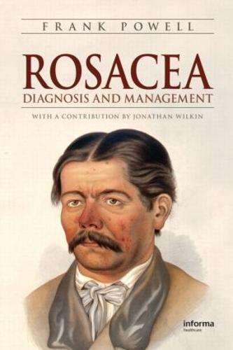 Rosacea