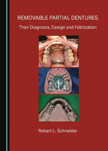 Removable Partial Dentures