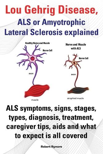 Lou Gehrig Disease, ALS or Amyotrophic Lateral Sclerosis explained. ALS symptoms, signs, stages, types, diagnosis, treatment, caregiver tips, aids and what to expect all covered.