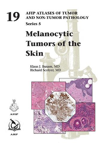 Melanocytic Tumors of the Skin