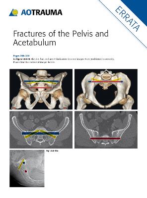 Fractures of the Pelvis and Acetabulum (AO)