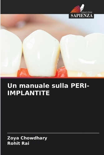 Un manuale sulla PERI-IMPLANTITE