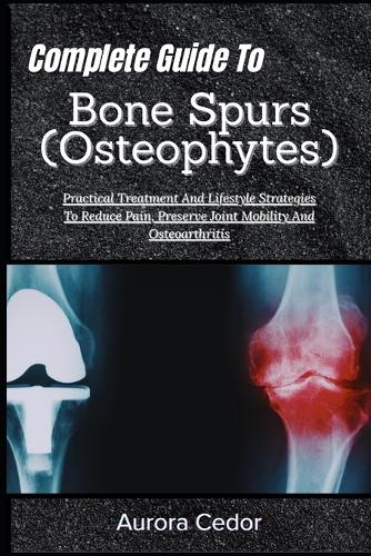 Complete Guide To Bone Spurs (Osteophytes)