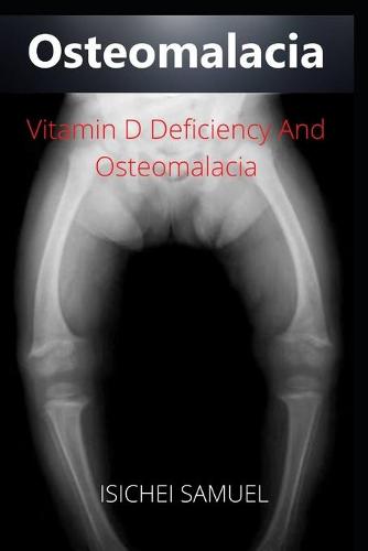 Osteomalacia